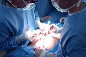 Operation for the increase in penis