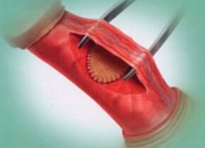 Surgical way to increase member