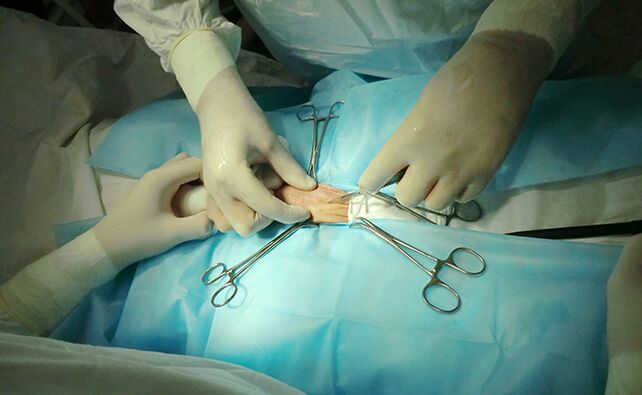 Surgery on the reproductive organ will help increase its size